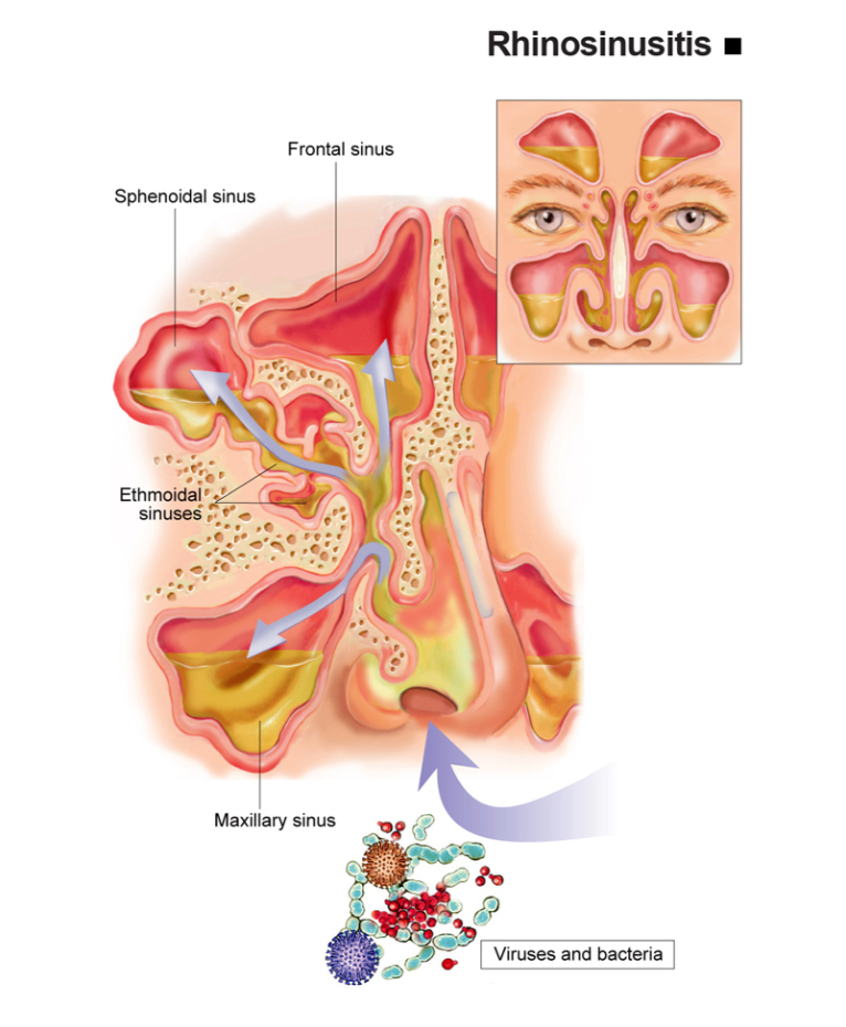 Rhinosinusitis