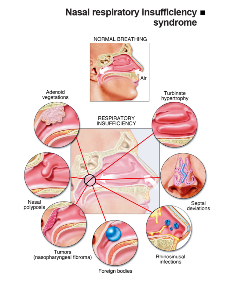 Nasal Respiratory Insufficiency