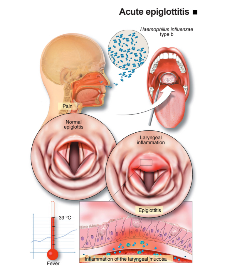 Epiglotitis Acute