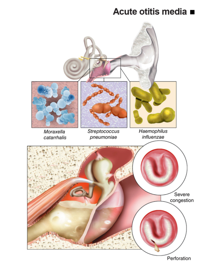 Otitis Media Akut (OMA)