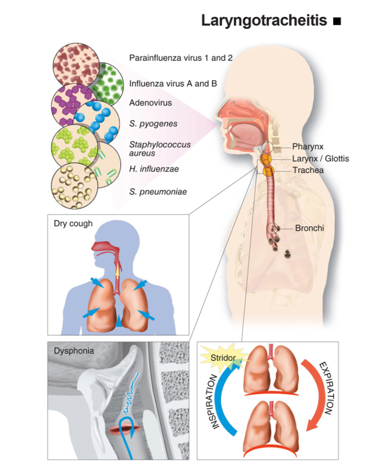 Laryngotracheitis