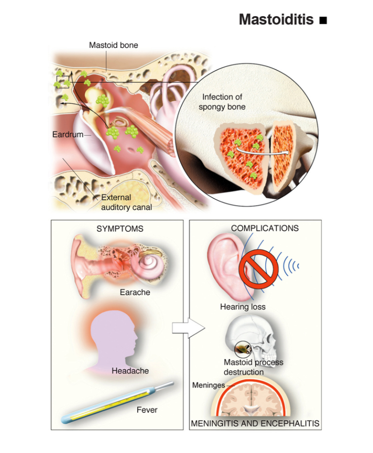 Mastoiditis