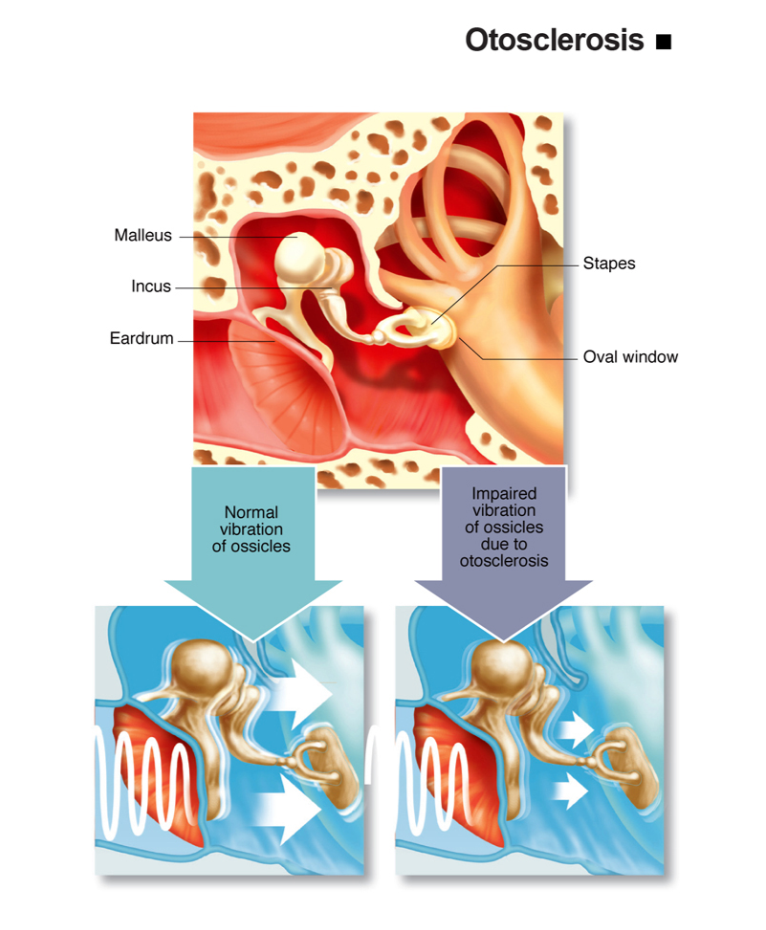 Otosclerosis