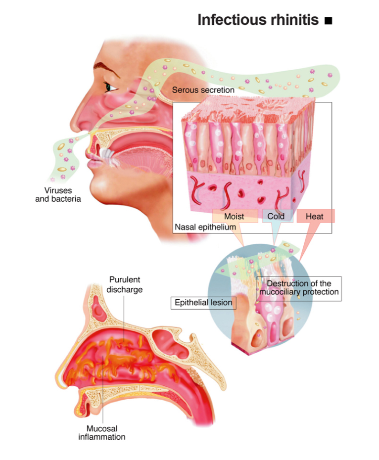 Infectious Rhinitis