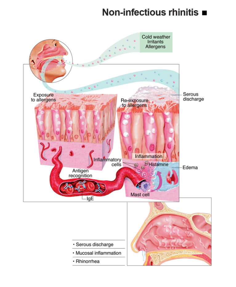 Non-Infectious Rhinitis