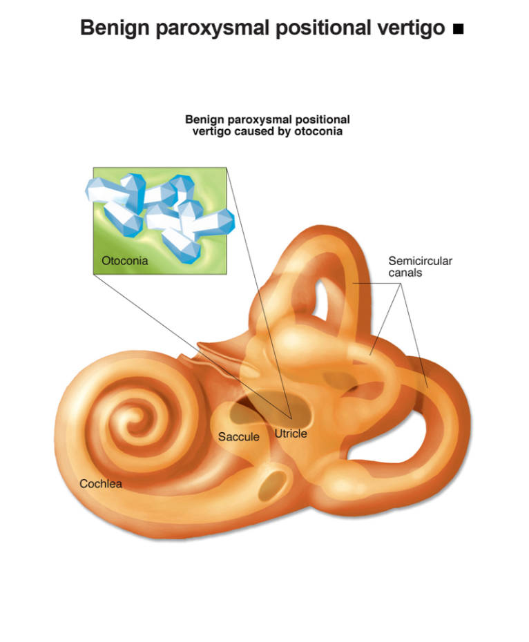 BPPV