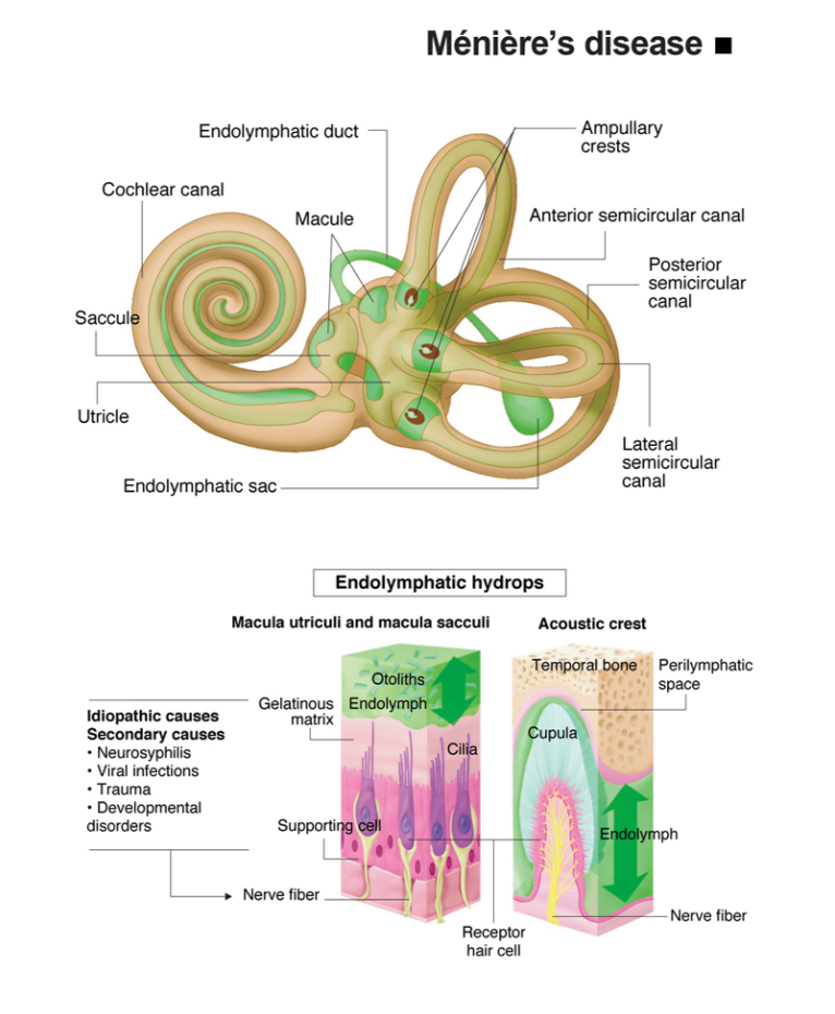 Meniere Disease
